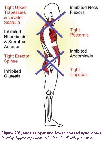 Better Posture Understanding Jandas Syndromes Whole Health Boston