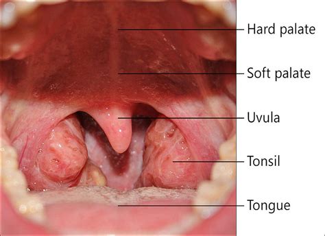 Palatine Uvula Wikidoc