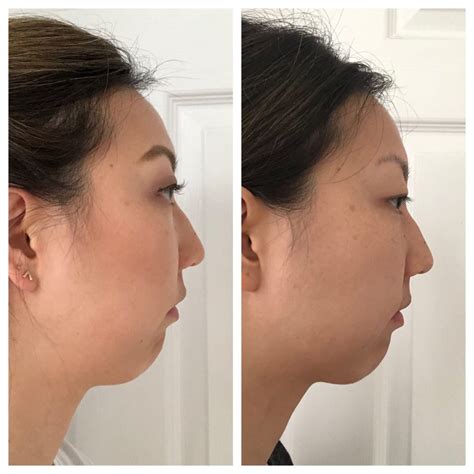 My Experience Getting Kybella Trend Envy