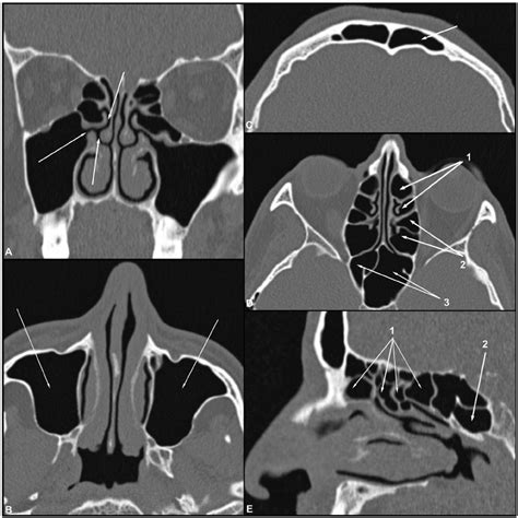 Ae Coronal Axial And Sagittal Ct Images Of The Bone Window
