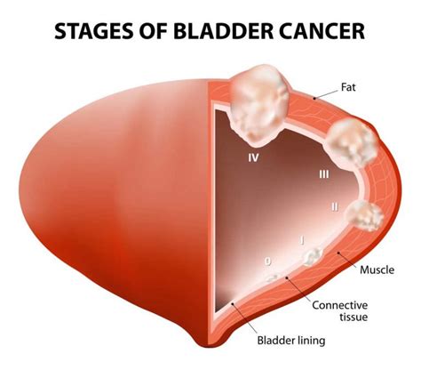 Bladder Cancer North Georgia Urology Center