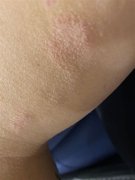 Developed Dry Patches On My Arms Babycenter