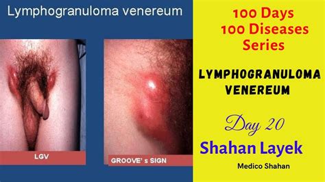 Lymphogranuloma Venereum LGV Shahan Layek 100 Days 100 Disease