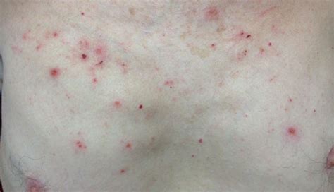 Derm Dx Itchy Rash On The Trunk Clinical Advisor