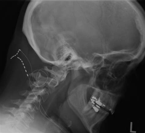 Occipital Nerve Stimulator Buyxraysonline