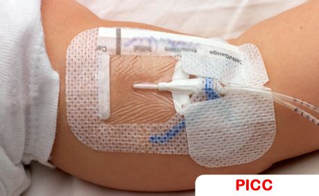 Cuidados de Enfermagem ao PICC Cateter Central de Inserção Periférica Enfermagem