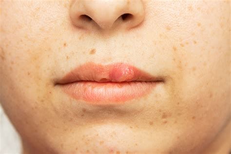 Foto De Herpes Oral Herpes Labial Bolhas Na Lips Herpes Simplex E Mais
