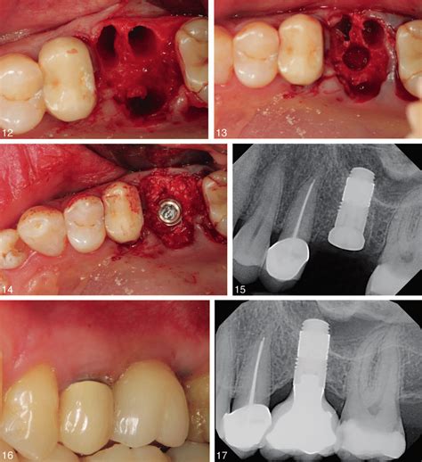 Case No 2 Atruamatic Extraction Of Tooth 14 Following Careful