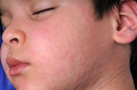 Vomiting, diarrhea, or belly cramps. Skin Allergies | Tri-State Allergy