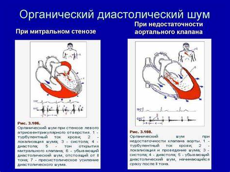 Диета при стенозе сердца