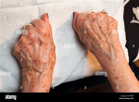 Age Spot Hi Res Stock Photography And Images Alamy