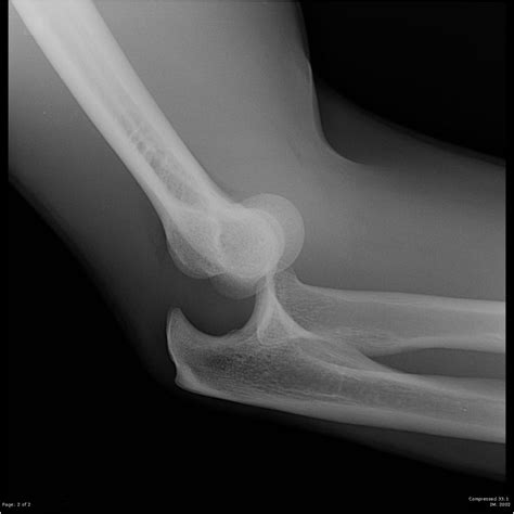 Posterior Elbow Dislocation