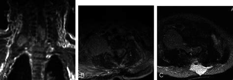 Postoperative A Axial Postcontrast Fat Saturated T1 Weighted And