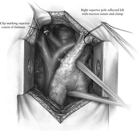 Radical Transsternal Thymectomy Operative Techniques In Thoracic And