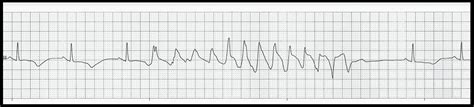 Ekg Rhythm Strip Quiz 213