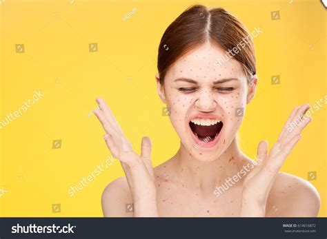 Womans Face Rash Face Pimples Woman Foto Stock Shutterstock