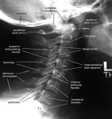 Normal C Spine Radiology Student Medical Anatomy Medical Knowledge
