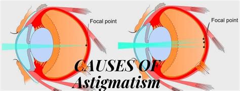 Astigmatism Causes Symptoms And Treatment Eyemantra