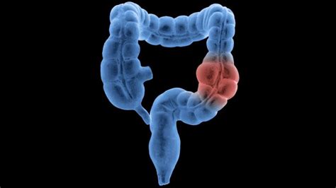 Colon And Rectal Cancer Screenings Should Start At 45 Updated