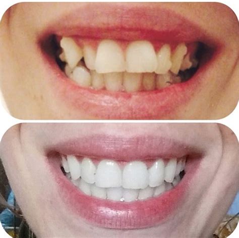 Beautiful Before And After Free Teeth Whitening With Every Invisalign