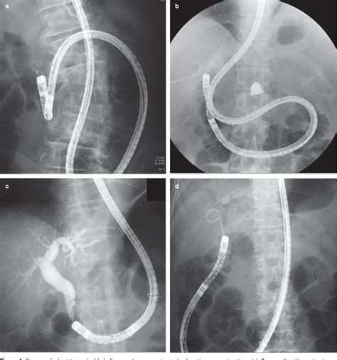 Figure 1 From How To Perform Balloon Assisted Enteroscopic Ercp
