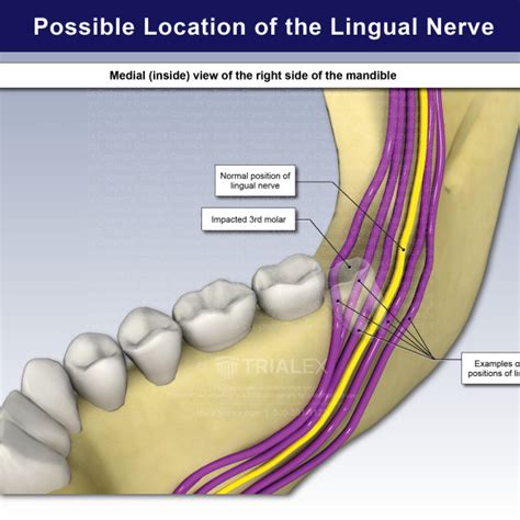 Possible Location Of The Lingual Nerve Trialexhibits Inc