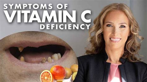Vitamin C Deficiency Diseases
