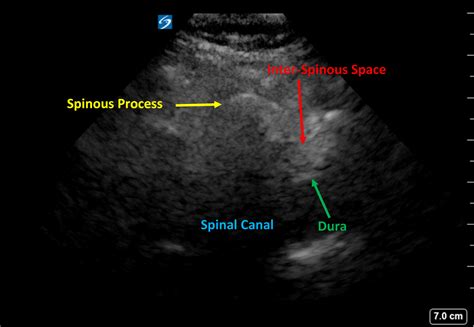 Getting To The Point Of Ultrasound Assisted Lumbar Punctures Sonomojo