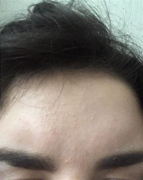 Skin Concerns Oilybumpybut Not Pimples On Forehead Tried