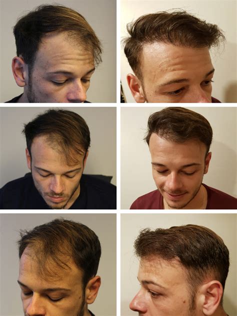 Photo greffe de cheveux homme avant après technique FUE