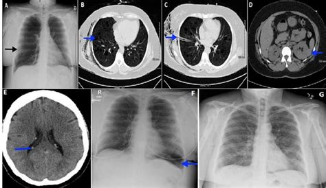 A Chest X Ray Showing Large Right Sided Pneumothorax Arrow B Ct