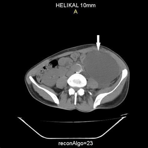 Postoperative Thoracoabdominal Computed Tomography Massive Chylous