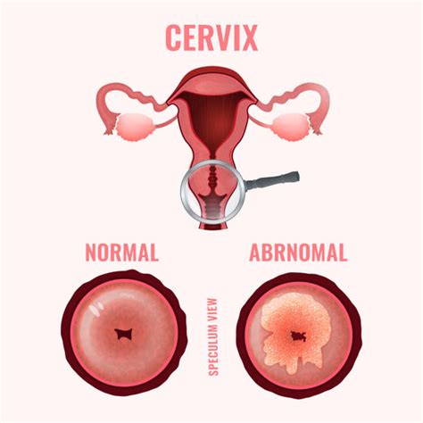 Cervical Cancer Anatomy