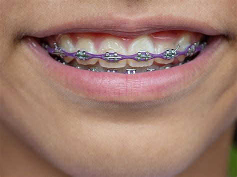 How Long Does It Take For Braces To Straighten Teeth Burlingame
