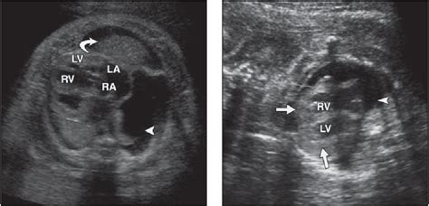 Figure 4 From Ultrasound Of Fetal Cardiac Anomalies Semantic Scholar