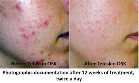 Acne Congested Skin Moments Cosmetic Medicine