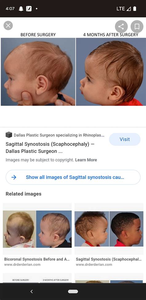 Sagittal Synostosis Press Dr If Youre Worried About Head Shape