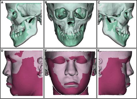 Bone Anchored Maxillary Protraction In A Patient With Complete Cleft