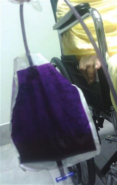 It is most frequently caused by an how does the urine bag become purple? Purple urine bag syndrome: A case report and review of ...