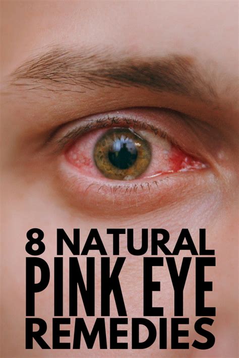 Home Remedies For Pink Eye 8 Natural Remedies For Pink Eye That Work