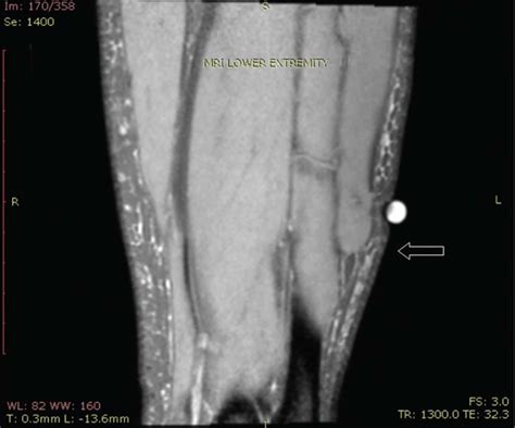 Fascial Hernia Definition Causes Symptoms Diagnosis And Treatment