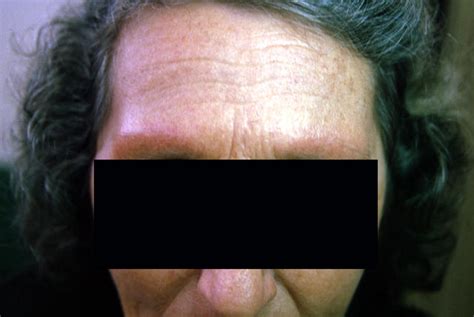 Follicular Syndromes With Inflammation And Atrophy Ulerythema