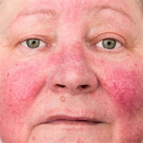 Sub Types Of Rosacea Understanding The Different Skin Conditions