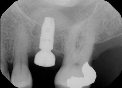 Sinus Elevationlift Dental Implants And Periodontics Of Ct