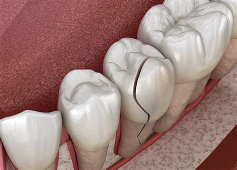 What Is Cracked Tooth Syndrome And How Is It Treated