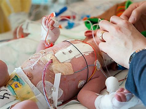 Crt May Help Infants Recover After Biventricular Heart Surgery