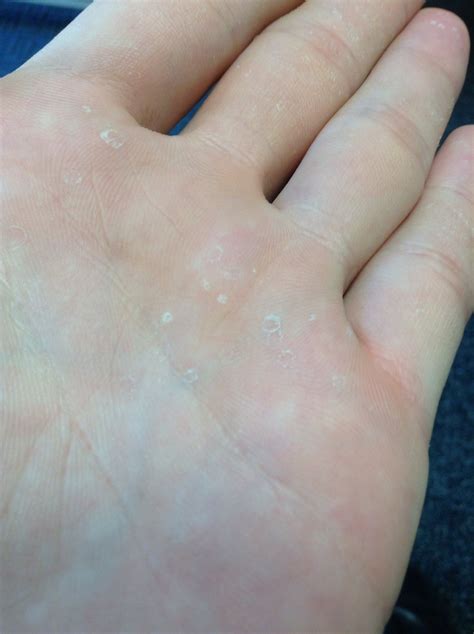 Skin Small White Peeling Circles On Hands Askdocs
