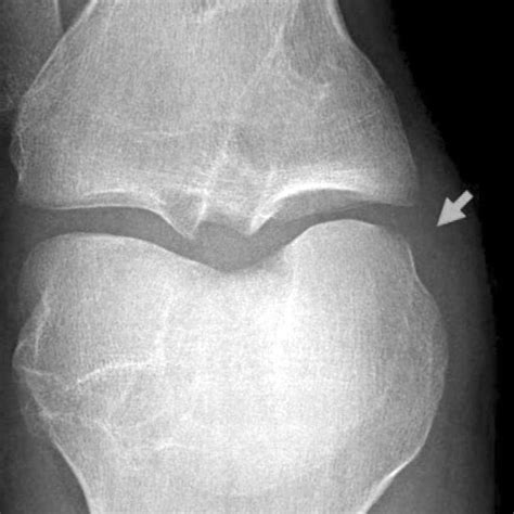 Intraoperative Photograph Shows Repaired Medial Meniscus Figure 2