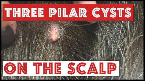 3 Cysts On The Scalp Pilar Cysts Youtube