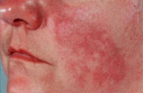 What Does A Lupus Rash Look Like